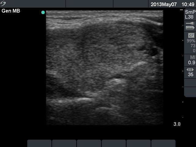 Right lobe, longitudinal scan