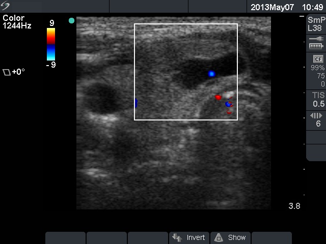 Right lobe, longitudinal scan
