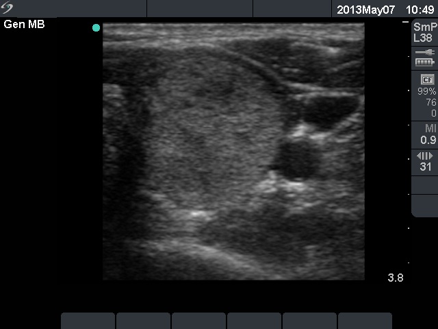Right lobe, longitudinal scan