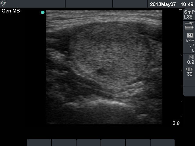 Right lobe, longitudinal scan