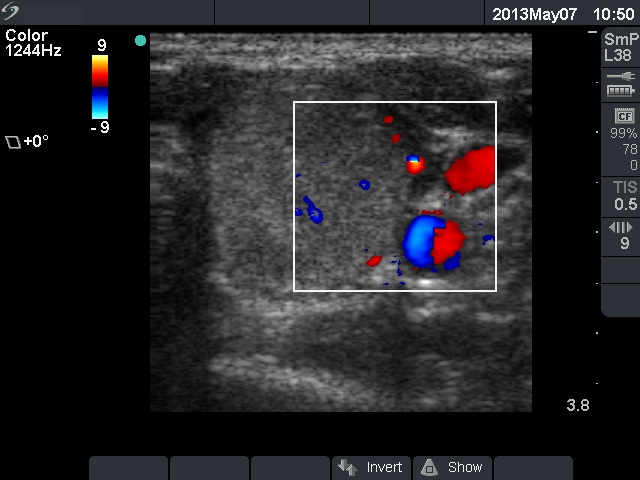 Right lobe, longitudinal scan