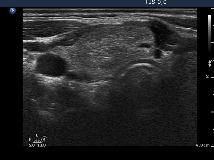 Right lobe, longitudinal scan