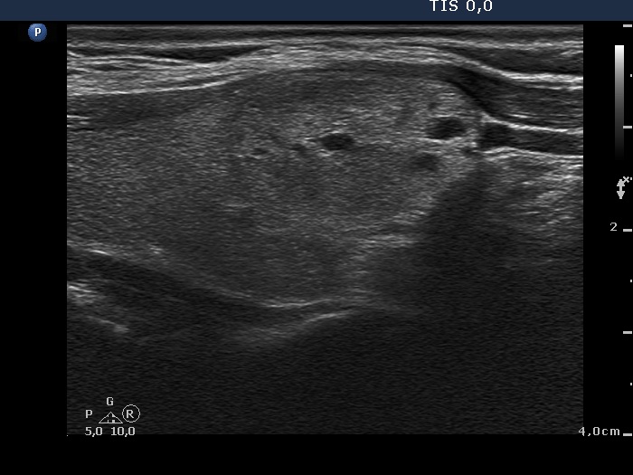 Right lobe, longitudinal scan