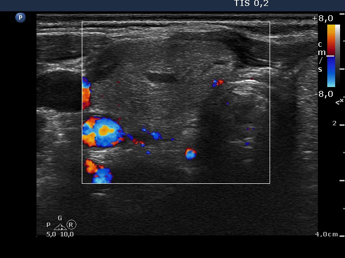 Right lobe, longitudinal scan