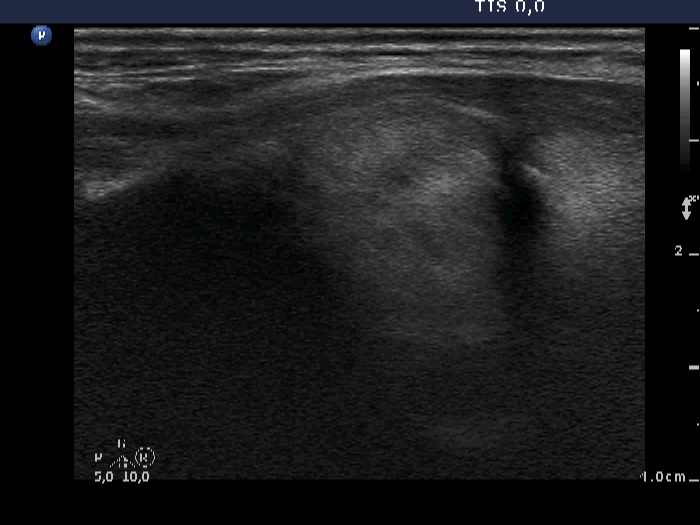 Right lobe, longitudinal scan