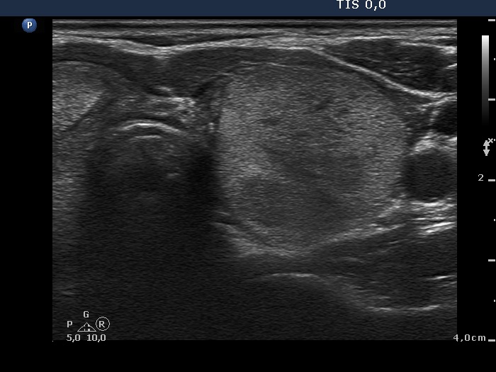 Right lobe, longitudinal scan