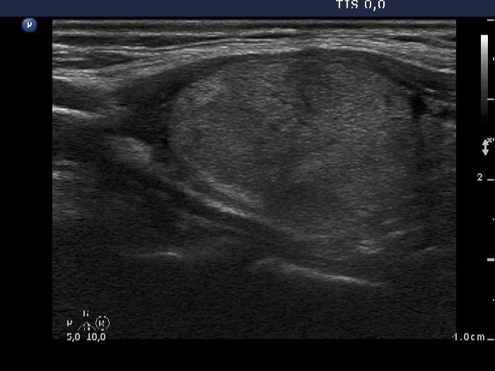 Right lobe, longitudinal scan