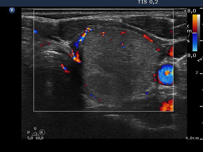 Right lobe, longitudinal scan