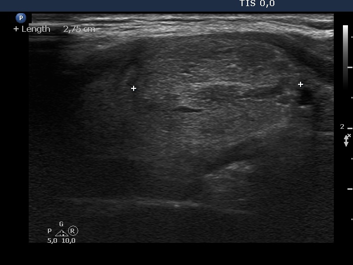 Right lobe, longitudinal scan