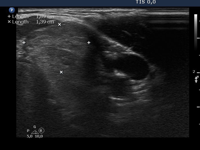 Right lobe, longitudinal scan