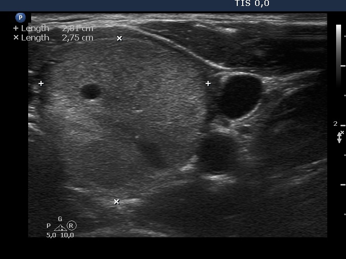 Right lobe, longitudinal scan