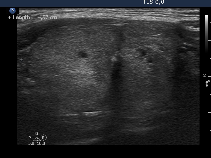 Right lobe, longitudinal scan