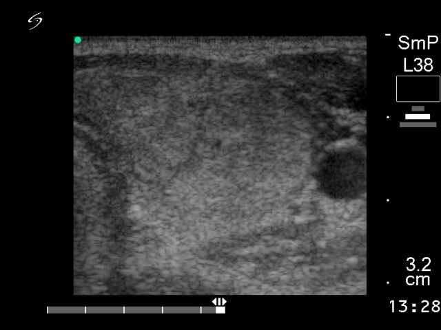 Right lobe, horizontal view