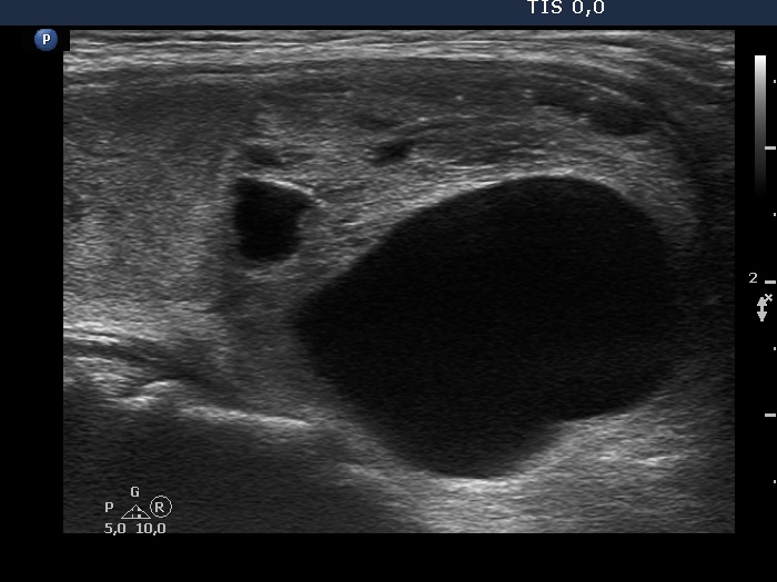 Right lobe, longitudinal scan