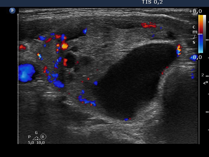 Right lobe, longitudinal scan