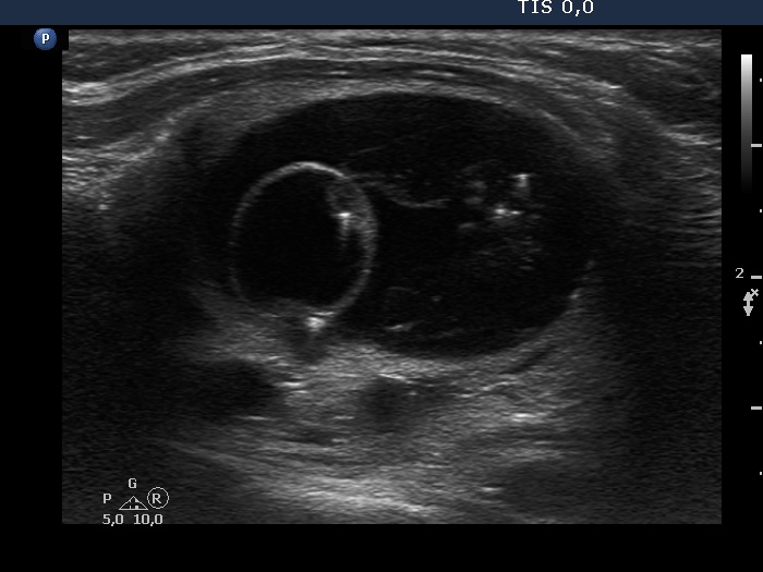 Right lobe, longitudinal scan