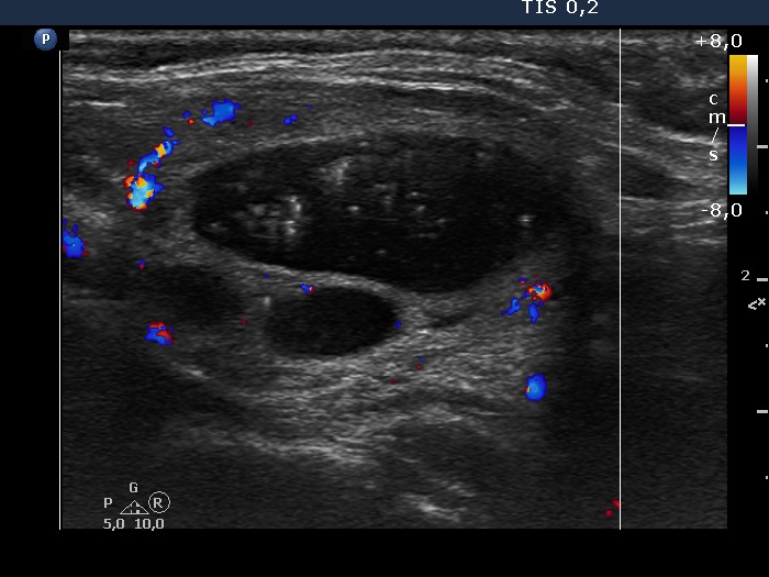 Right lobe, longitudinal scan