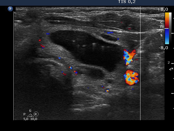 Right lobe, longitudinal scan