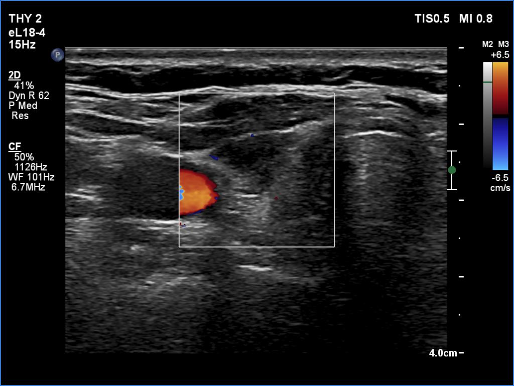 Right lobe, longitudinal scan