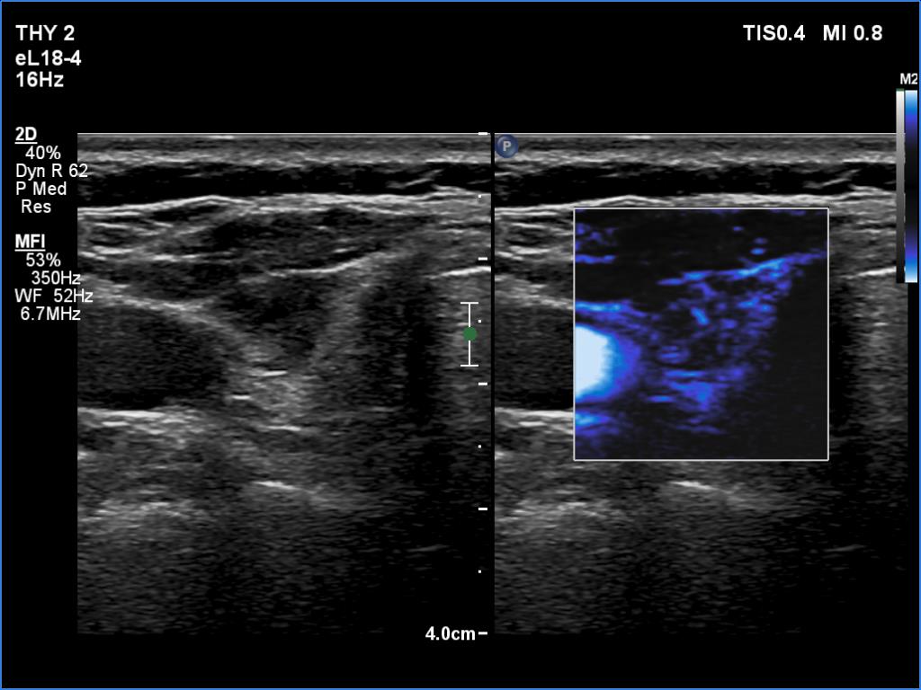 Right lobe, longitudinal scan