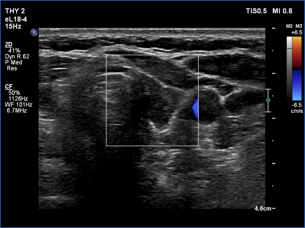 Right lobe, longitudinal scan