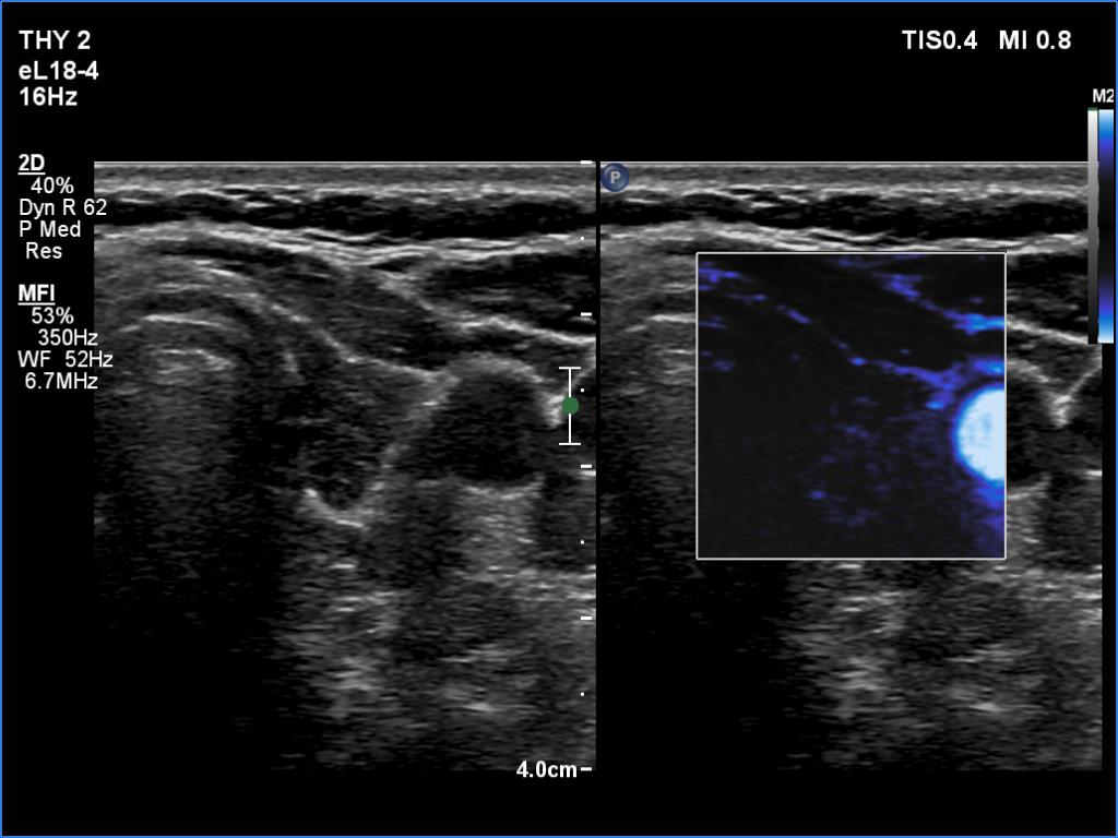 Right lobe, longitudinal scan