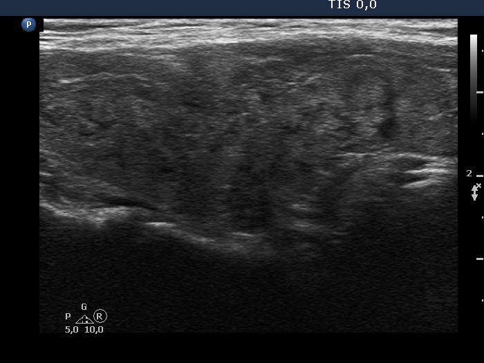 Right lobe, longitudinal scan