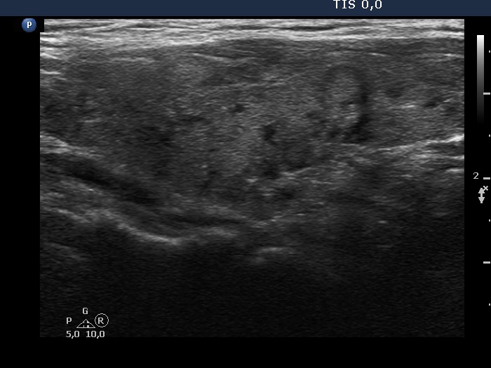 Right lobe, longitudinal scan