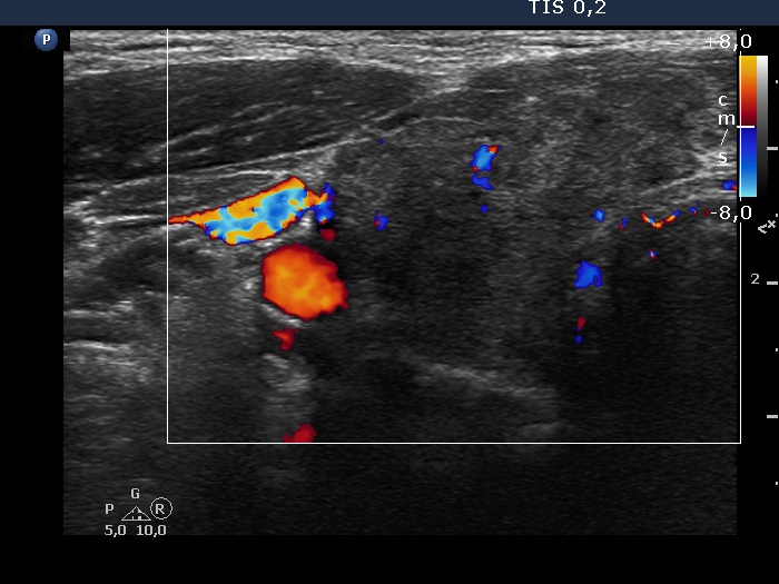 Right lobe, longitudinal scan
