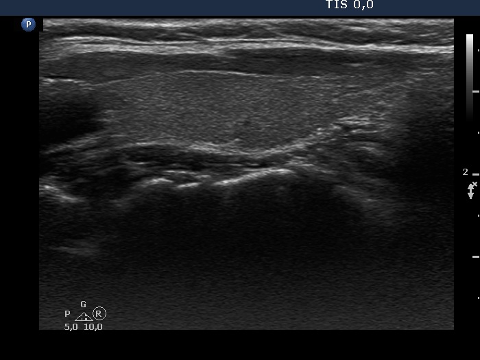 Right lobe, longitudinal scan