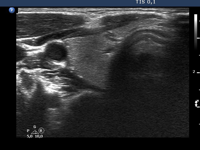 Right lobe, longitudinal scan