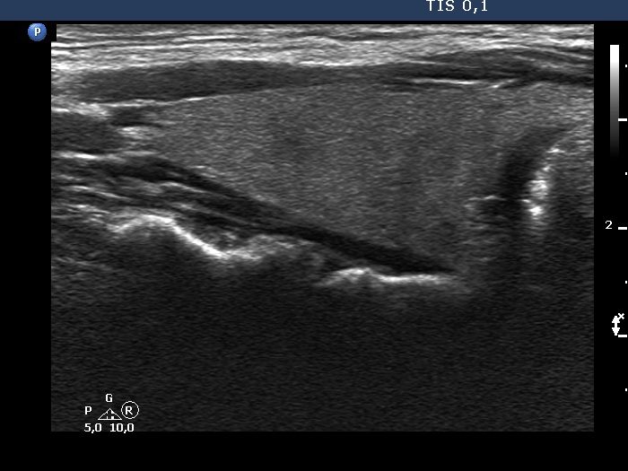 Right lobe, longitudinal scan
