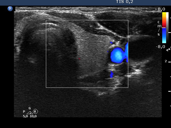 Right lobe, longitudinal scan