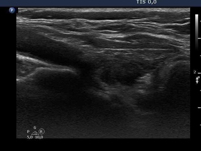 Right lobe, longitudinal scan