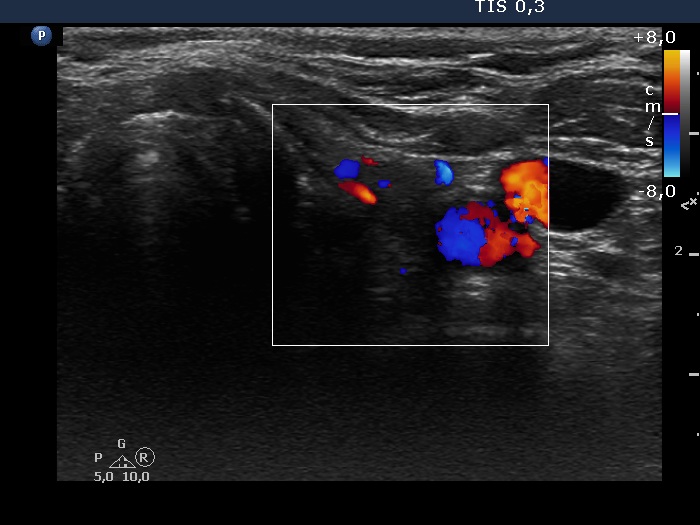Right lobe, longitudinal scan
