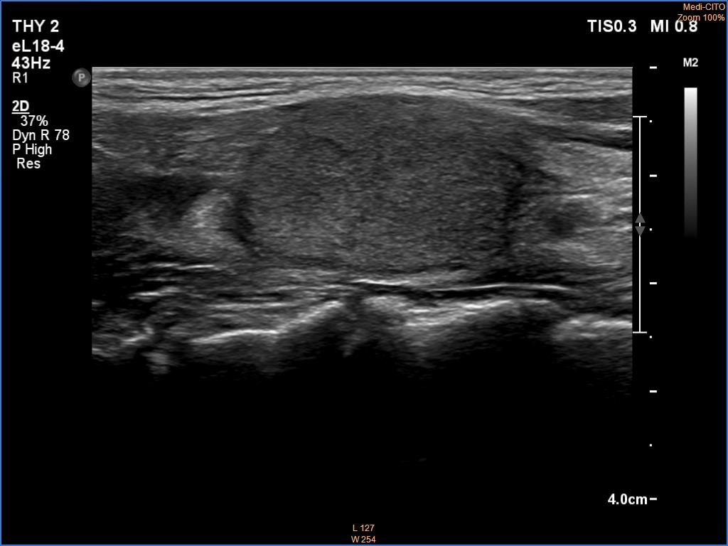 Right lobe, longitudinal scan