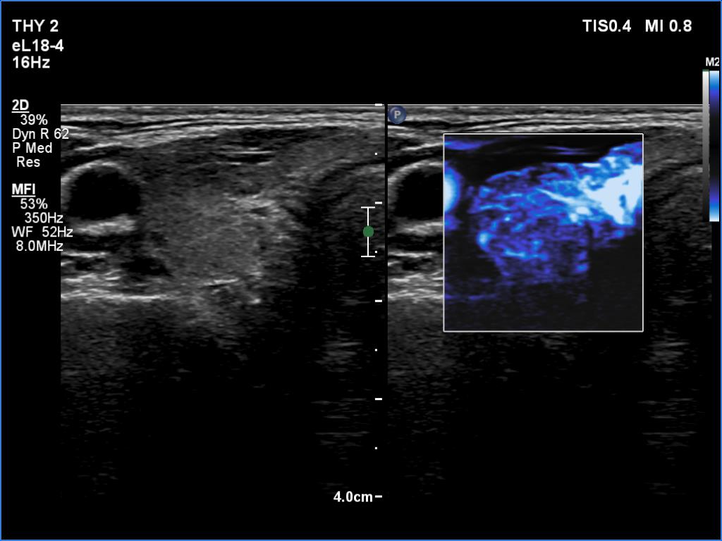 Right lobe, longitudinal scan