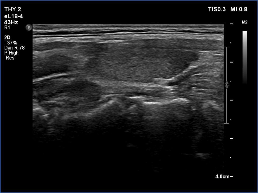 Right lobe, longitudinal scan