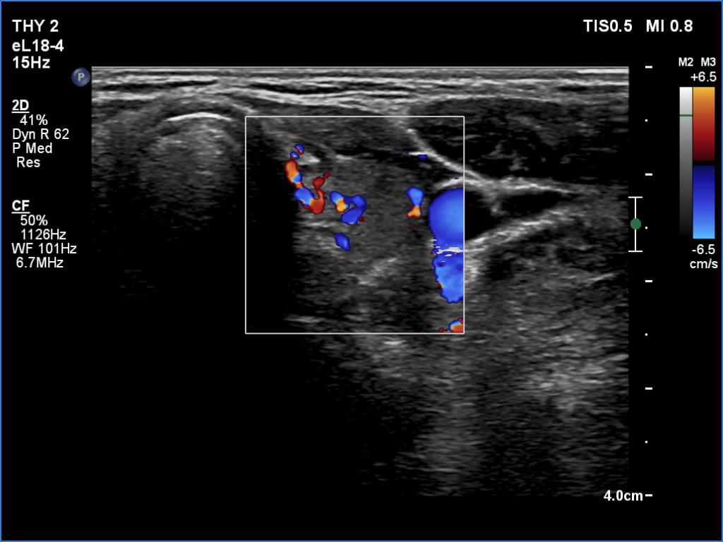 Right lobe, longitudinal scan