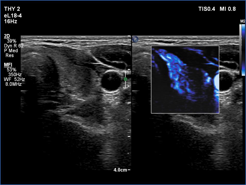Right lobe, longitudinal scan