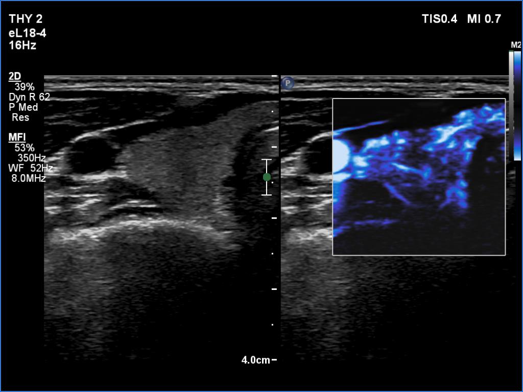 Right lobe, longitudinal scan