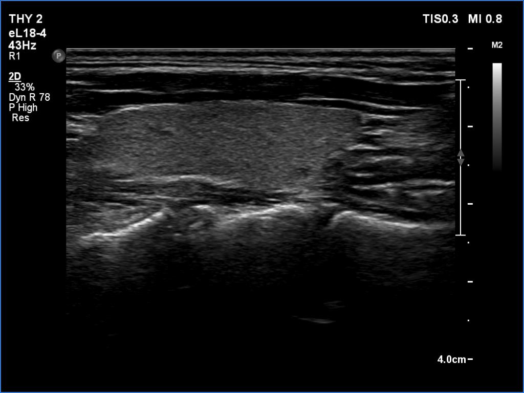 Right lobe, longitudinal scan