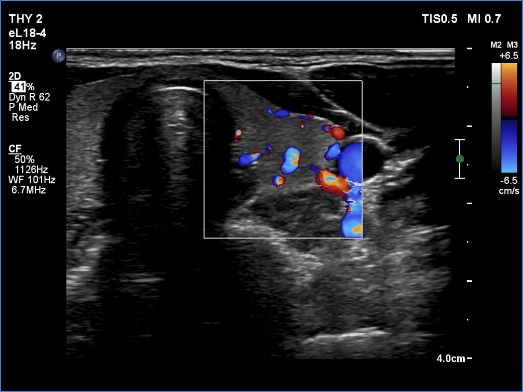 Right lobe, longitudinal scan