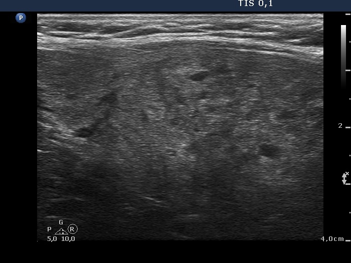 Right lobe, longitudinal scan