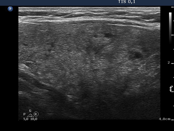 Right lobe, longitudinal scan