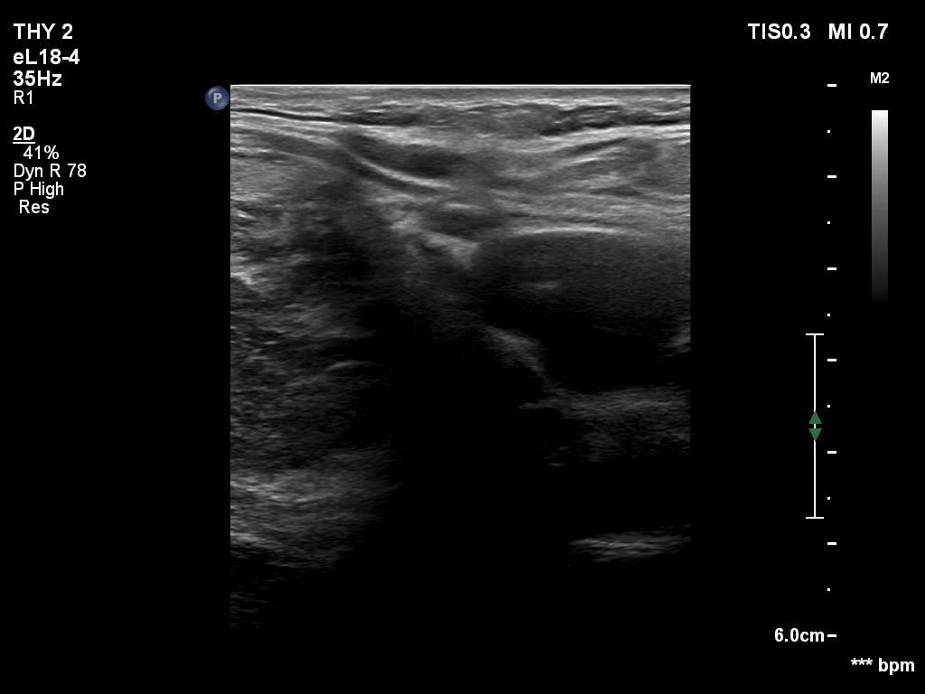 Right lobe, longitudinal scan
