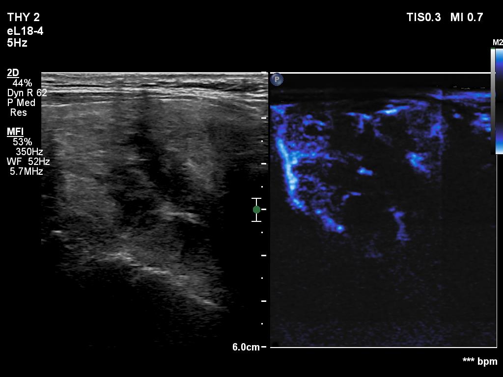 Right lobe, longitudinal scan