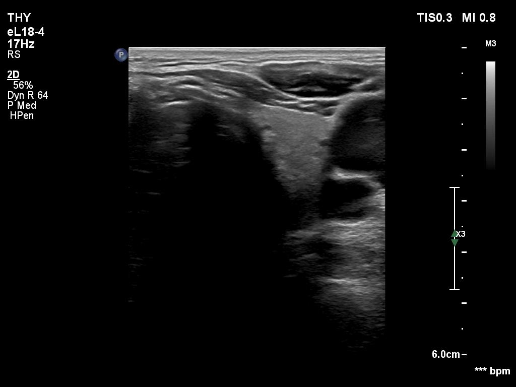 Right lobe, longitudinal scan