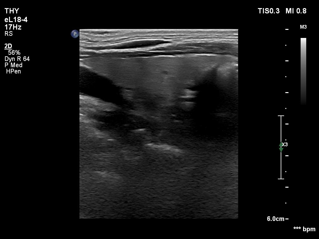 Right lobe, longitudinal scan