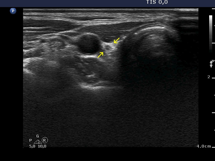 Right lobe, longitudinal scan
